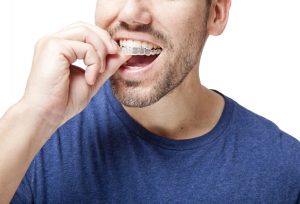 cost of invisalign