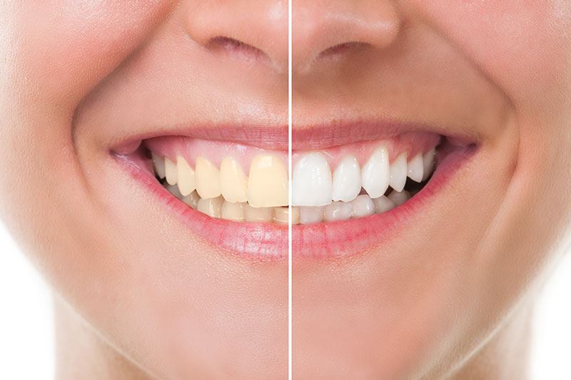 Teeth Whitening in Arlington Heights, IL 60004